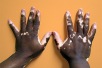 World Vitiligo Day 2024