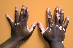 World Vitiligo Day 2026